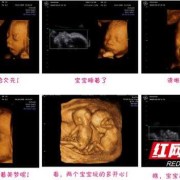 孕期b超做多了会影响胎儿吗（孕晚期多久做一次b超合适？做多了对胎儿有影响吗）