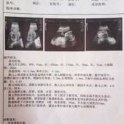 建议胎儿超声心动检查（建议胎儿超声心动检查）
