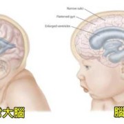 脑硬膜下积液怎么办,胎儿脑内积水怎么办36周