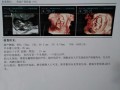 孕11周胎儿稳定了吗（我怀孕11周了，没有任何反应，这是怎么回事呢）