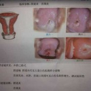 孕期宫颈出血怎么回事（孕期宫颈充血有炎症，一直出血怎么办）