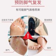 孕期有脚气怎么办（孕期有脚气怎么办用什么可以止痒）