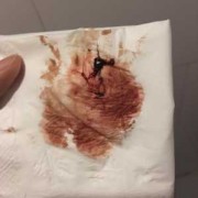 怀孕两周会出血吗？怀孕早期女性身体会有什么症状,出血又不像来月经怎么回事