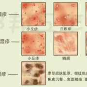 孕妇为什么生湿疹,怀孕期间长湿疹的原因有哪些