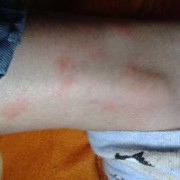 孕期湿疹是如何引起的（孕妇脚上会有湿疹是怎么回事）
