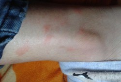 孕期湿疹是如何引起的（孕妇脚上会有湿疹是怎么回事）