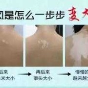 白癜风具有遗传性吗,自癜风能在孕期自愈吗女性