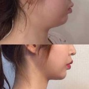 胎儿下颚短小（什么样的下巴属于短的）