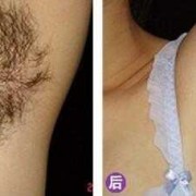 孕期激光脱毛（孕期激光脱毛对胎儿有影响吗）
