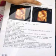 双肾盂未见分离是什么意思,胎儿双侧肾盂无分离是男是女