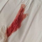 孕期肛门滴血（孕期肛门滴血不痛血色鲜红）