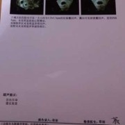 胎儿没胎心是什么原因，是什么原因导致的呢,胎儿无心跳是什么原因导致的