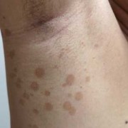 孕妇身上长了花斑癣怎么办,孕期花斑癣怎么治疗最好