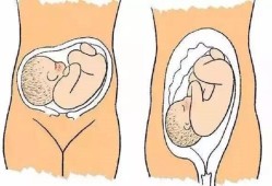 胎儿横位都是怀女孩吗（31周，胎儿横位怎么办）