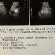 b超检查胎儿胆囊偏大该怎么办？请问胎儿胆囊大有什么坏处,胎儿胆囊偏大严重吗?