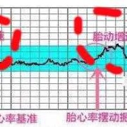 胎心监护胎儿动的厉害（胎心监护胎儿动的厉害胎心率快）