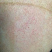 孕期肚子一块红的很痒,孕期肚子痒有小红疙瘩怎么回事