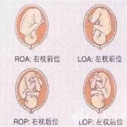 左枕位胎儿图（胎方位:LOP是什么意思）