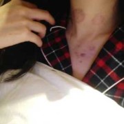 b超胎儿颈部见u型压痕（压痕和吻痕的区别）