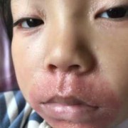 宝宝嘴巴周围起了五六个小红疙瘩是怎么回事,胎儿 唇部最佳检查时间