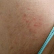 孕期身上红疙瘩（孕妇腿上起红疙瘩还很痒要怎么办）