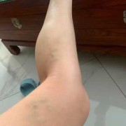 孕期腿酸（孕期腿酸）