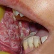 孕期口腔瘤（孕妇口腔癌）