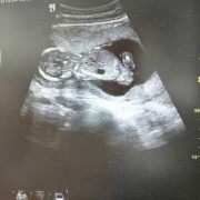 怀孕15周就有胎动正常吗,孕15周胎儿稳定了吗?我反应几乎没有了