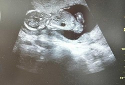 怀孕15周就有胎动正常吗,孕15周胎儿稳定了吗?我反应几乎没有了