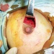 孕期乳腺纤维瘤（有乳腺纤维瘤可以怀孕吗）