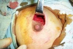 孕期乳腺纤维瘤（有乳腺纤维瘤可以怀孕吗）