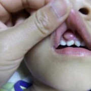 孕期牙龈出血是怎么回事,孕期牙龈肿了个肉坨怎么消肿