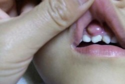 孕期牙龈出血是怎么回事,孕期牙龈肿了个肉坨怎么消肿