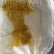 胎儿油症（为什么宝宝大便会油油的）
