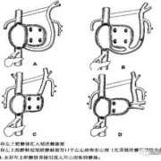 胎儿左上腔静脉永存（胎儿左上腔静脉永存）