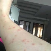 孕妇得湿疹怎么办,孕期丘疹性荨麻疹怎么办