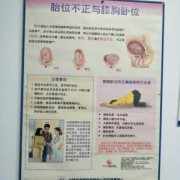 胎位是LSA怎么办,如何改变胎儿体位姿势