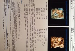五个月四维彩超单说胎儿上唇连续是什么意思,胎儿上唇尚连续