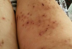 孕期身上痒怎么办（孕期身上痒怎么办越挠越痒,特别是晚上）