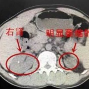 胎儿双肾大小不一致左肾3.4*2.0cm，右肾2.7*1.6cm有影响吗,胎儿双肾偏大是畸形吗怎么治疗