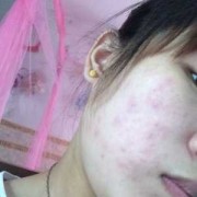 怀孕初期脸上长痘痘,怀孕期间长痘痘是什么原因