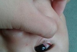 胎儿一只眼（一岁孩子眼睛红是怎么回事）