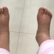 孕期脚变大能恢复吗（孕期脚变大会恢复吗）