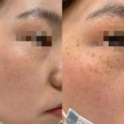 孕期雀斑（妊娠斑如何治疗）
