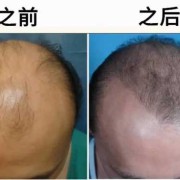 怀孕后汗毛加重是怎么回事,孕期雄激素高对胎儿影响