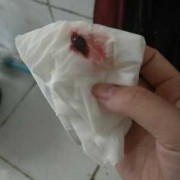 边缘性前置胎盘老是反复流血，怎么办,孕期反复出血但查了都没事的宝妈