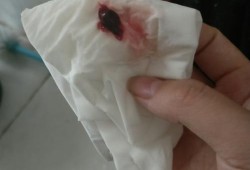 边缘性前置胎盘老是反复流血，怎么办,孕期反复出血但查了都没事的宝妈