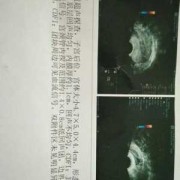 怀孕26周四维彩超显示胎盘两侧缘可及带状回声相连是什么原因,胎儿颈部见脐带回声呈u型压迹什么意思
