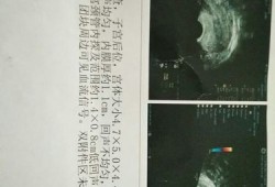 怀孕26周四维彩超显示胎盘两侧缘可及带状回声相连是什么原因,胎儿颈部见脐带回声呈u型压迹什么意思