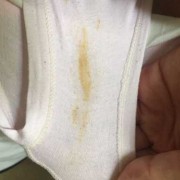 孕期白带发黄粘稠图片（怀孕了白带发黄是怎么回事）